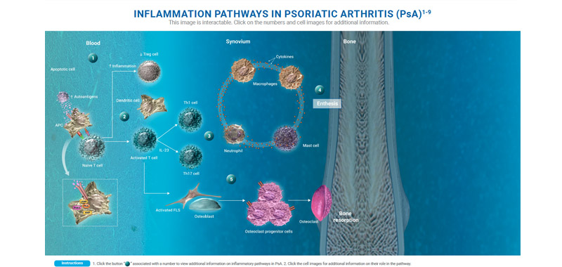 Inflammation in PsA